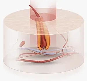 Во время процедуры лазерной эпиляции