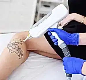 Удаление татуировок в Алматы