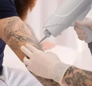 Удаление татуировок в Алматы