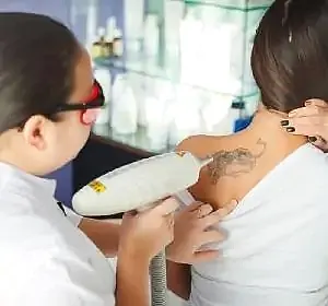 Удаление татуировок в Алматы